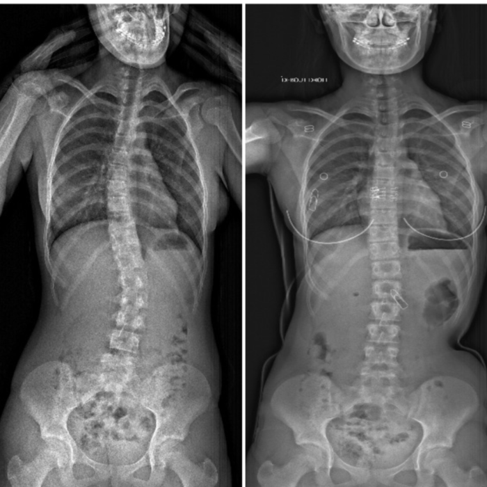 Radiographie EOS d’une patiente avec scoliose sans corset (à gauche) et avec
corset (à droite)