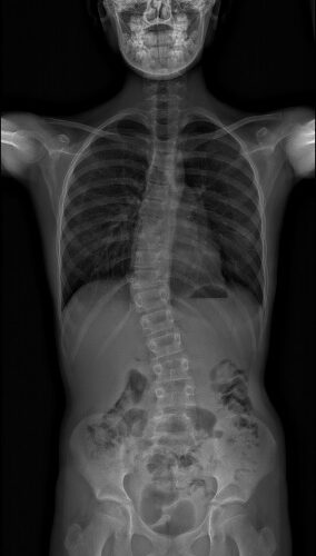 scoliose enfant 01