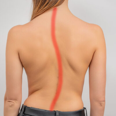 Woman with scoliosis of the spine. Curved woman's back.
